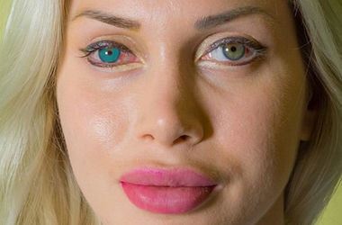 Хирургическое изменение цвета глаз: как это выглядит (фото,видео)
